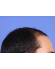 Before Hair Transplant&nbsp;Front
